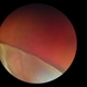 Retinal Dialysis (Superior) and Macula Off Detachment