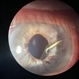 Iris hooking the Intraocular Lens Iris hooking the Intraocular Lens