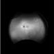 Branch retinal artery occlusion Branch retinal artery occlusion