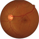 Congenital Retinal Macrovessel Congenital Retinal Macrovessel