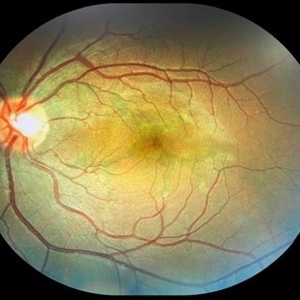 RPE Tear After Anti-VEGF Injection - Retina Image Bank