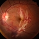 Choroidal Rupture Choroidal Rupture