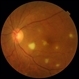Endogenous Endophthalmitis
