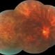 Central Retinal Vein Occlusion Central Retinal Vein Occlusion