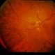 Idiopathic Pre-Retinal Membrane / Vitritis Idiopathic Pre-Retinal Membrane / Vitritis