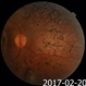 Macular Coloboma and Pigmentary Retinopathy Macular Coloboma and Pigmentary Retinopathy