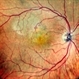 Retinal Angiomatos Proliferans Retinal Angiomatos Proliferans