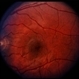Solar Retinopathy / Familial Solar Retinopathy / Familial