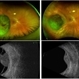 Choroidal Melanoma