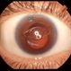 Anterior Iris Claw Artisan Lens Anterior Iris Claw Artisan Lens