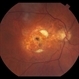 Disciform Scar Due to Exudative Macular Degeneration Disciform Scar Due to Exudative Macular Degeneration
