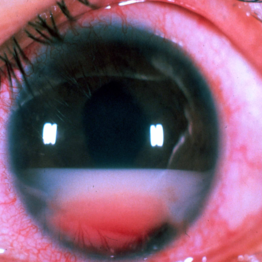 Large B Cell Lymphoma of the Retina - Retina Image Bank