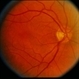 Macular Hole Evolving / Lamellar Hole Macular Hole Evolving / Lamellar Hole