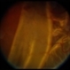 Giant Retinal Tear Giant Retinal Tear