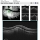 Focal Scleral Nodule Focal Scleral Nodule