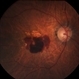 Subretinal Hemorrhage Due to SRNVM, Color Photograph