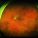 Sunset Glow Fundus Sunset Glow Fundus