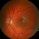 Epiretinal Membrane Epiretinal Membrane