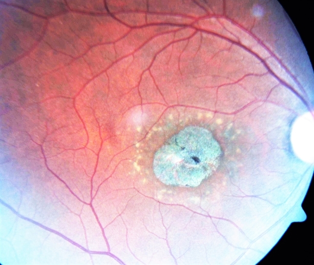 Macular Dystrophy Retina Image Bank macular-dystrophy-retina-image-bank