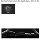 Synechiae