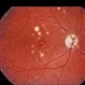 Ocular Histoplasmosis Syndrome Ocular Histoplasmosis Syndrome