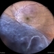 Rhegmatogenous Retina Detachment