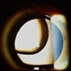 Superiorly Subluxated Crystalline Lens