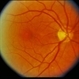 Macular Hole Evolving / Lamellar Hole Macular Hole Evolving / Lamellar Hole