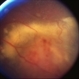 Retinal Angioma Retinal Angioma