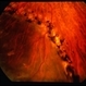 Angioma from Chronic Retinal Detachment Angioma from Chronic Retinal Detachment