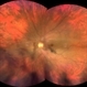 Horseshoe Tear with Vitreous Hemorrhage Horseshoe Tear with Vitreous Hemorrhage