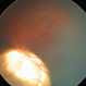 Chorioretinal Coloboma with Retinal Detachment Chorioretinal Coloboma with Retinal Detachment