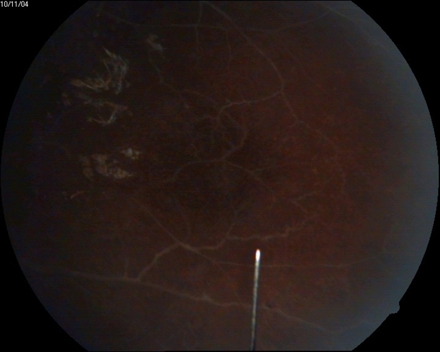 Eales Disease Retina Image Bank