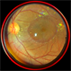 Central Serous Chorioretinopathy : Smartphone Fundus Image
