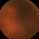 Scleritis Scleritis