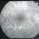 Syphilitic Chorioretinitis Syphilitic Chorioretinitis