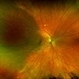 Isolated Choroidal Melanocytosis - Montage Isolated Choroidal Melanocytosis - Montage