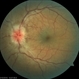 Hypotony Maculopathy Hypotony Maculopathy