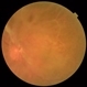 Branch Retinal Vein Occlusion-Posterior Hyaloid Proliferation