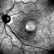Chronic Full Thickness Macular Hole