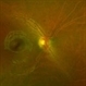 Lipemia Retinalis OD Lipemia Retinalis OD