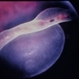 Dislocated Lens With Retinal Detachment