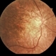 Pentosan Maculopathy Color Fundus Photo Right