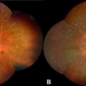 Gyrate Atrophy of the Choroid and Retina Gyrate Atrophy of the Choroid and Retina