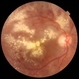 Severe Exudative Diabetic Retinopathy - Right Eye Severe Exudative Diabetic Retinopathy - Right Eye