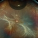 Retinal Detachment with PVR Retinal Detachment with PVR