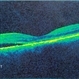 Choroidal Hemangioma