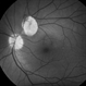 Retinal Astrocytic Hamartoma Retinal Astrocytic Hamartoma