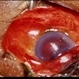 Trauma – Scleral Laceration Trauma – Scleral Laceration