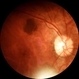 Choroidal Nevus Choroidal Nevus